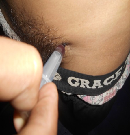 Abscess & Wound Management
